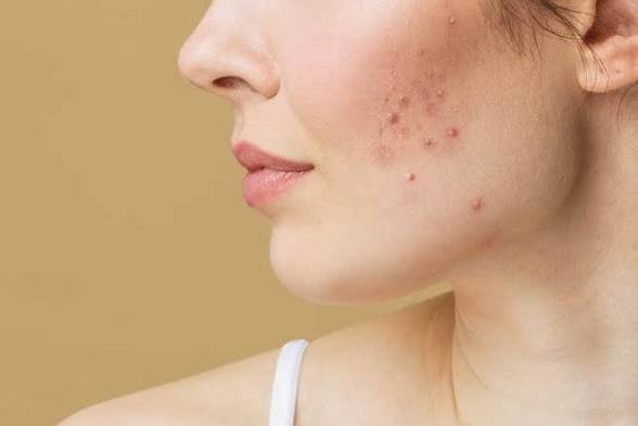 Adult acne is common, but effective treatments are available