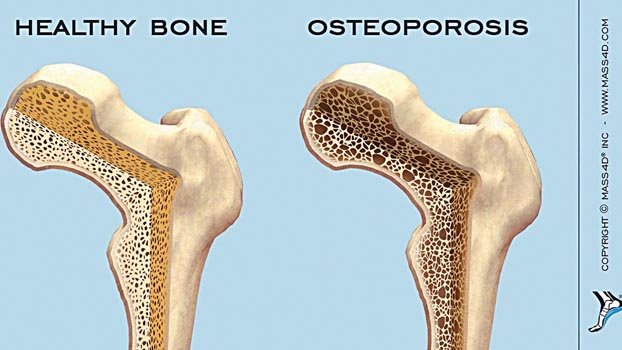 Creating awareness on osteoporosis stressed