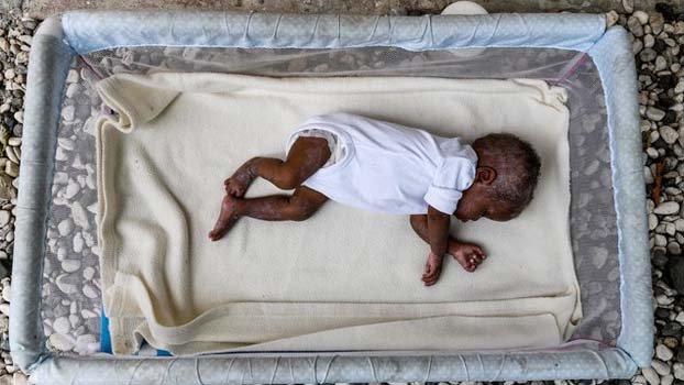 Pandemic to bring surge in child wasting cases: UN