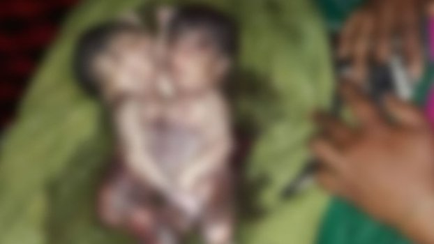 Twins born with conjoined chest-abdomen