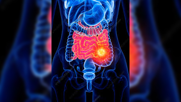 Small bowel cancer causes & risk factors - Bangladesh Post