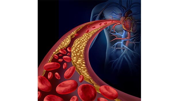 Symptoms, causes of Dyslipidemias (Part 3)