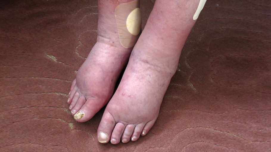 Edema, its symptoms (part 1)