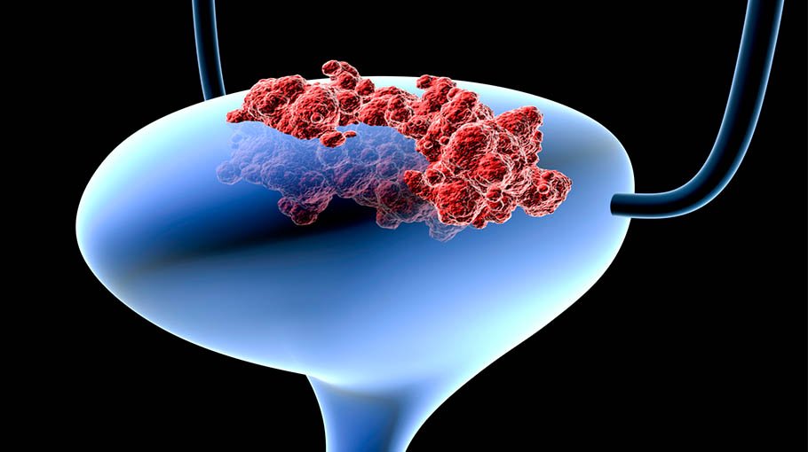 Bladder cancer, its  symptoms (part 1)