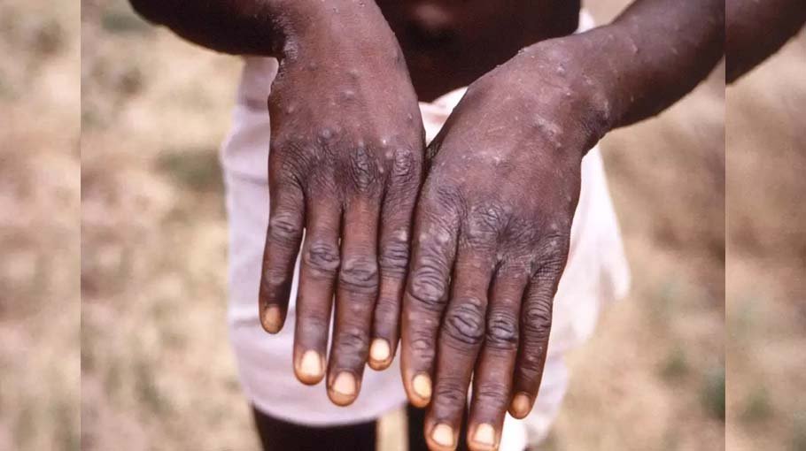 How worried should you  be about monkeypox?