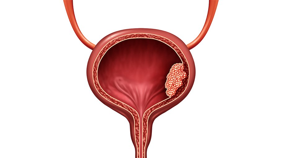 How to prevent bladder cancer (part 5) Bangladesh Post