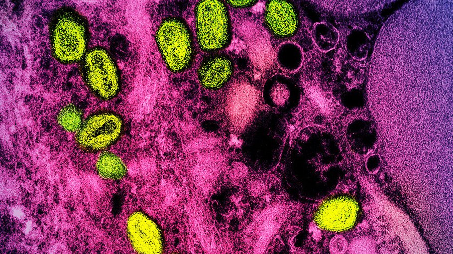 Second US monkeypox death as virus linked to brain inflammation