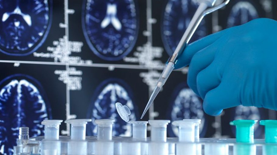 Scientists discover how brain cells die in Alzheimer’s