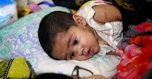 Sylhet records another suspected measles death