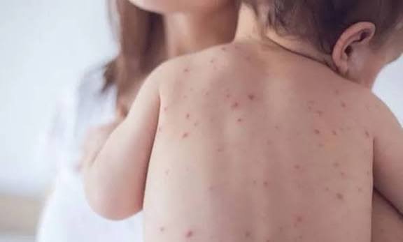 4 more children die with measles symptoms