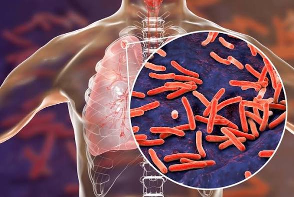 New blood test offers hope for earlier TB detection