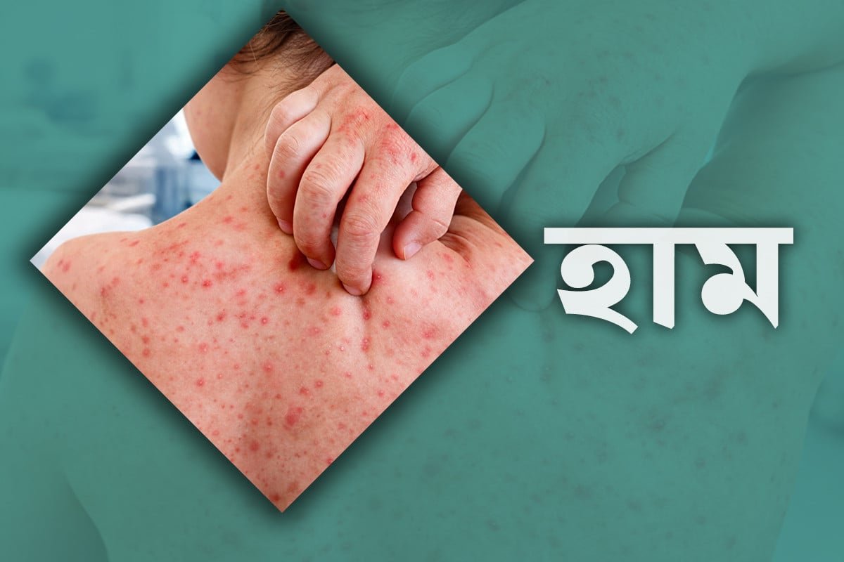 Eight more deaths reported amid Bangladesh measles outbreak